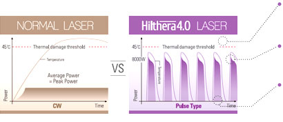 Hilthera-Innovative_technology : Normal laser VS HILTHERA4.0 laser